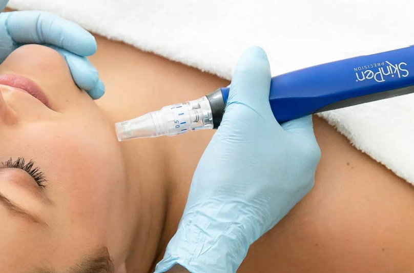 SkinPen Microneedling