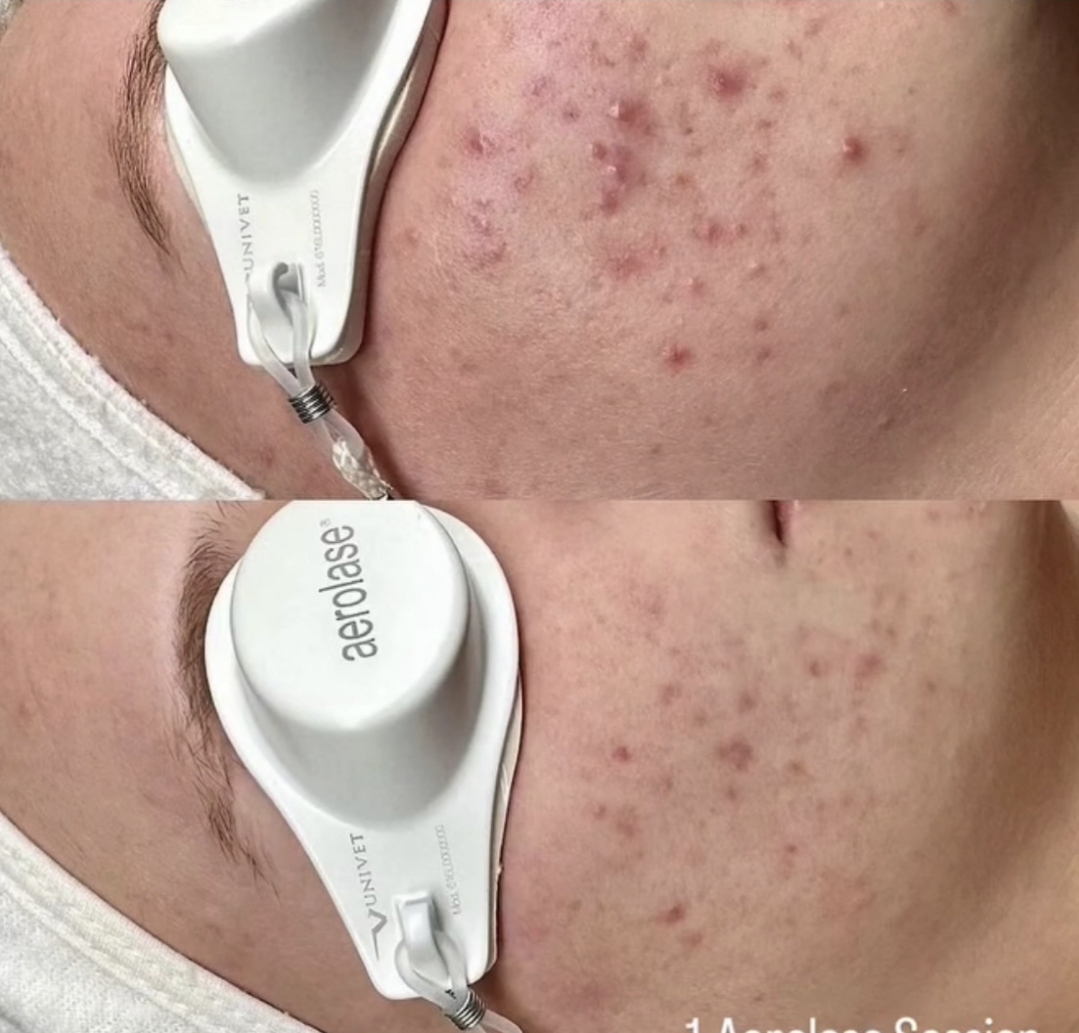 Acne & congestion transformation