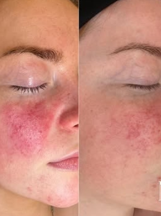 Rosacea & redness transformation